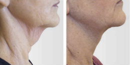 RF-ReFacing-Methode, Premium Beauty Institut RF-ReFacing-Methode, Premium Beauty Institut Natalja Schmidt, Dreieich