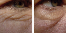 RF-ReFacing-Methode, Premium Beauty Institut RF-ReFacing-Methode, Premium Beauty Institut Natalja Schmidt, Dreieich