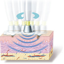 RF-ReFacing strafft in der Tiefe der Epidermis RF-ReFacing strafft in der Tiefe der Epidermis